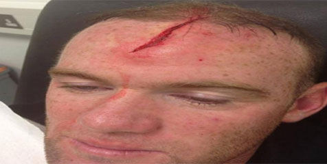 Wujud Asli Cedera Kepala Rooney