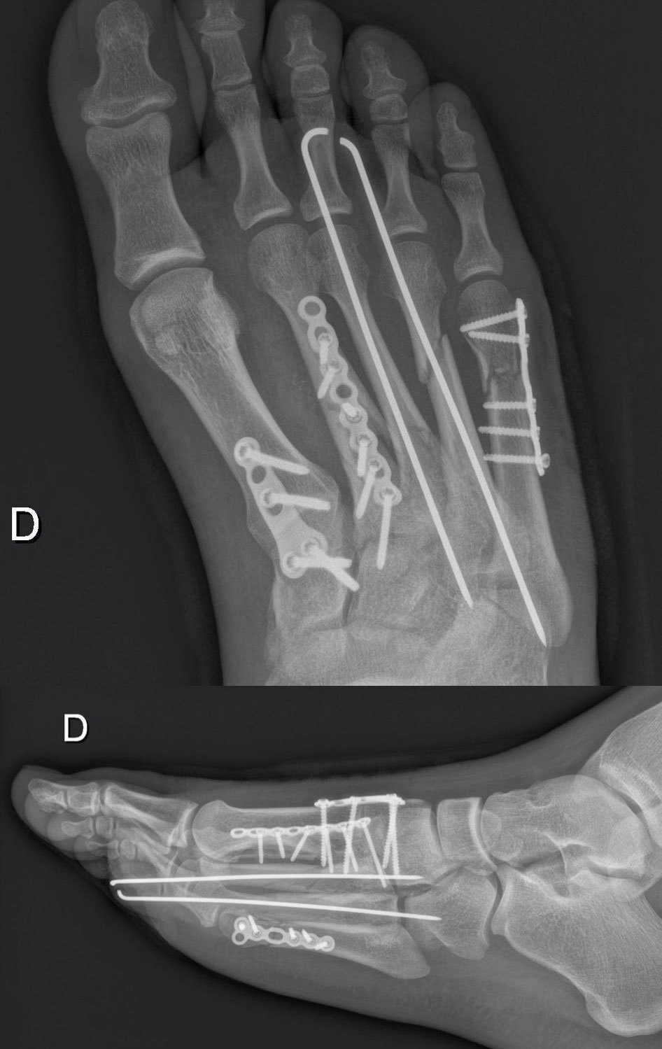 Kaki kanan Loris Baz pascaoperasi di Swiss. (c) Avintia Racing