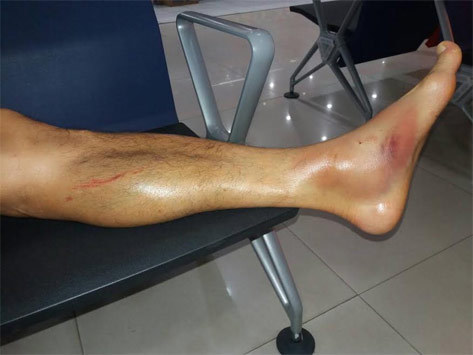 Kondisi engkel Hong Soon-Hak.