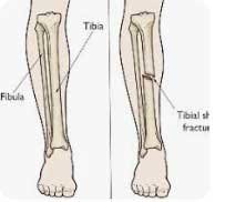 Gambar ilustrasi tulang tibia (c) Istimewa