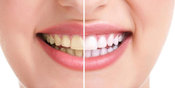 Pahami Cara-Cara Memutihkan Gigi Secara Alami
