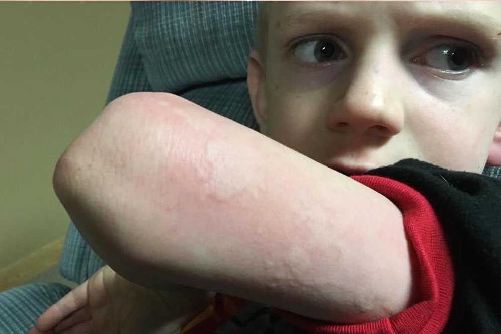 Waspadai Gejala Biduran dan Pahami Tips Pencegahannya