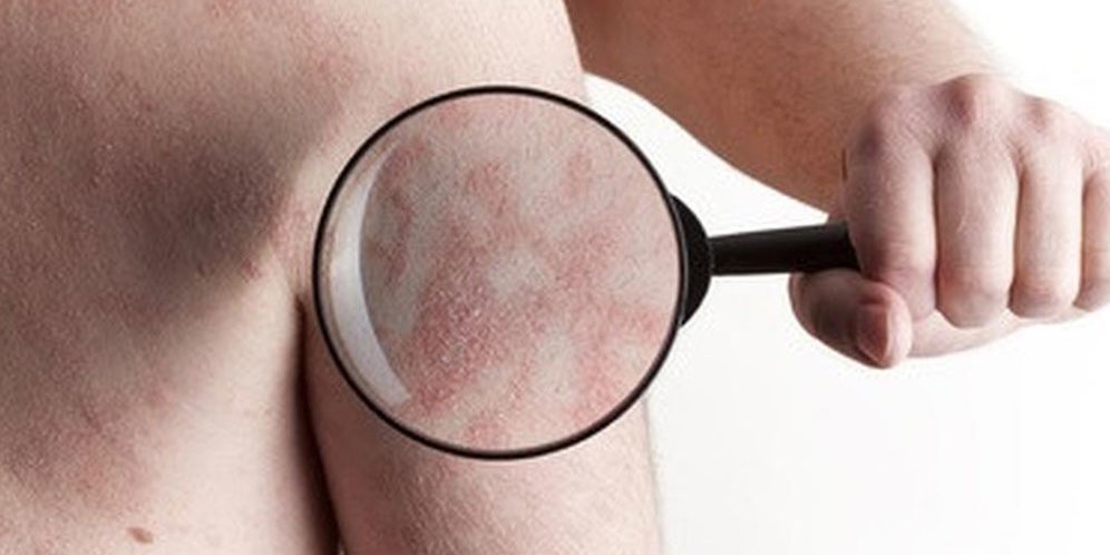 Waspadai Gejala Eksim dan Pahami Cara Mengatasinya Waspadai Gejala Eksim dan Pahami Cara Mengatasinya