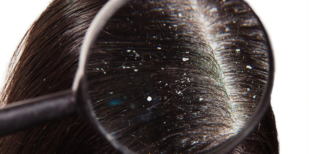 Ampuh, Pahami Cara-Cara Atasi Ketombe Secara Alami