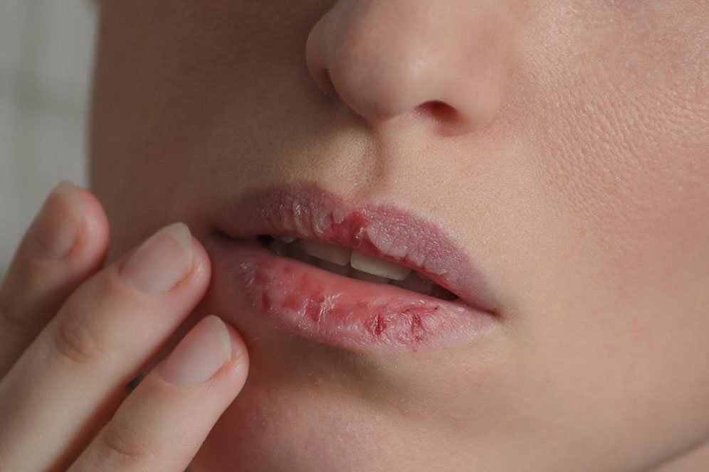 Waspadai Deretan Masalah Kesehatan yang Ditandai Bibir Pecah-Pecah Waspadai Deretan Masalah Kesehatan yang Ditandai Bibir Pecah-Pecah