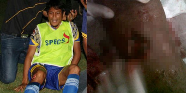 Kaki Iqbal Samad Berlubang Terkena Petasan Suporter Persisam