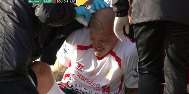 Video: Staf Medis Liverpool Tancapkan Staples ke Kepala Skrtel Video: Staf Medis Liverpool Tancapkan Staples ke Kepala Skrtel