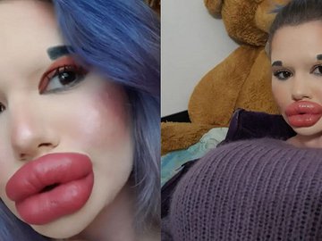 Ini Potret Terbaru Perempuan dengan Bibir Terbesar, Bakal Lakukan Injeksi yang ke-27