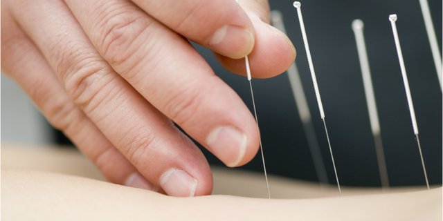 Terapi Akupunktur Bisa Tingkatkan Produksi ASI