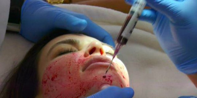 Viral! Perawatan Kecantikan Facial Vampir, Berani Coba?