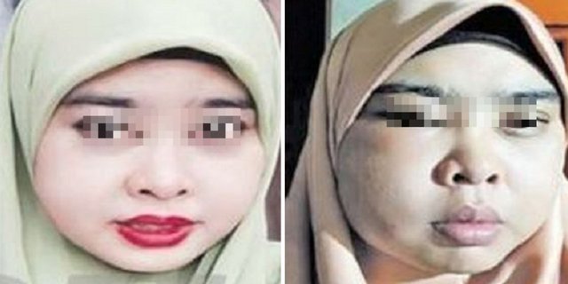 Tergiur Krim Pemutih, Wajah Perempuan Ini Berakhir Bengkak