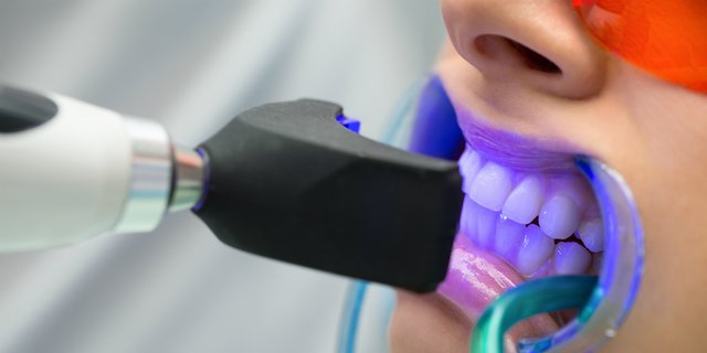 Efek Mengerikan Tren Pemutihan Gigi di Kalangan Remaja