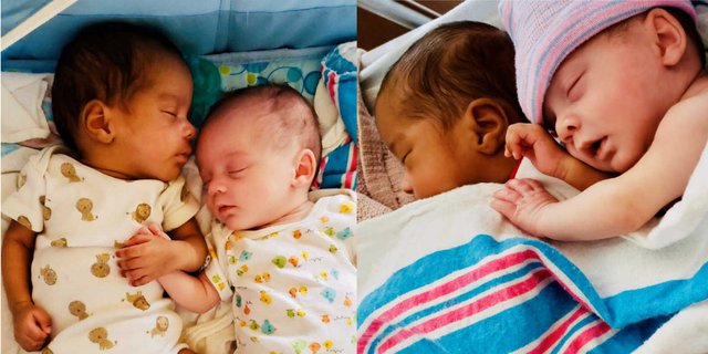 Unik, Ada Bayi Kembar dengan Warna Kulit Berbeda