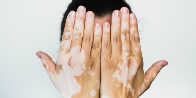 Vitiligo, Gangguan Autoimun yang Menyerang Kulit