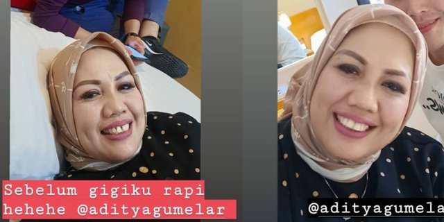 Penampilan Elly Sugigi Sebelum dan Sesudah Potong Gigi