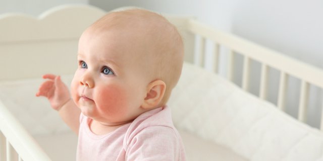 Mengenal Jenis Penyakit Kulit Bayi dan Cara Mencegahnya