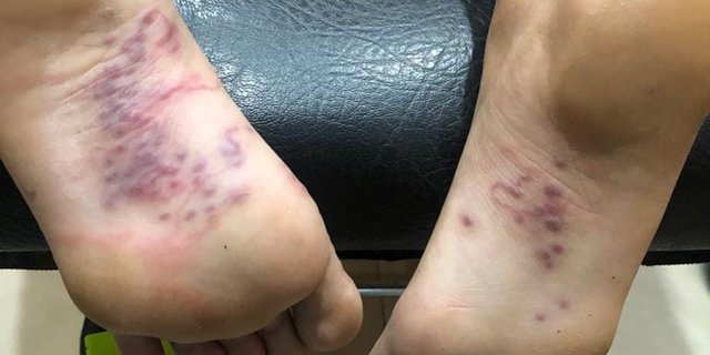 Viral Telapak Kaki Dimasuki Cacing di Batam, Ternyata Begini Penjelasan Medisnya