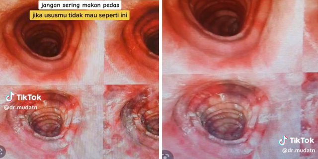 Scary! Patient Complains of Repeated Stomach Pain, Turns Out His Intestines are Perforated Because of Eating Spicy Food