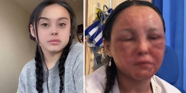 This is the Horrifying Appearance of a Beautiful Girl with Severe Eczema, Her Skin Peels and Her Face Swells Making It Hard to Open Her Eyes