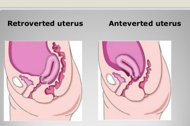 Tak Banyak Yang Tahu Posisi Rahim Bisa Juga Terbalik Parenting Dream Co Id