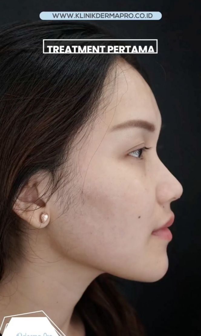Adu Potret Ayu Ting Ting VS Jessica Iskandar yang Sama-sama Lakukan Perbaikan Bentuk Hidung, Penampilan Barunya Ramai Tuai Cibiran!