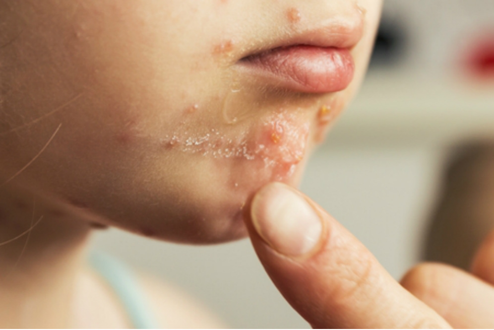 Impetigo Penyakit Kulit Yang Sangat Mudah Menulari Si Kecil