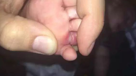 Jempol bayi luka