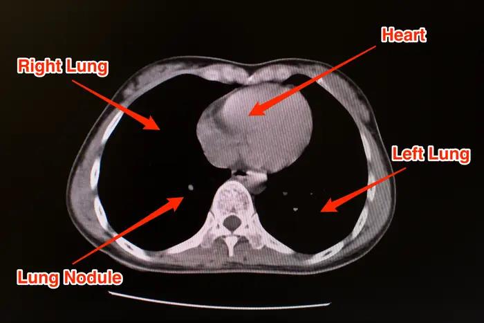  Kondisi paru-paru yang normal akan berwarna hitam saat dilakukan pemindaian CT scan.