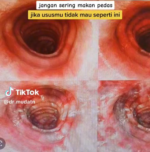 Condition of the intestines of patients who often eat spicy food.