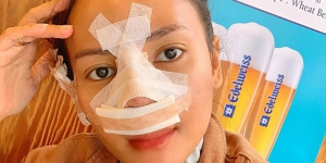 Cerita Rachel Goddard Operasi Hidung Demi Sembuhkan Sinus