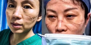 Viral Wajah Suster Rawat Pasien Virus Corona Penuh Luka dan Tanda Bekas Masker