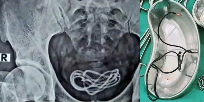 Kabel Charger 60 Cm Nyangkut di Kandung Kemih, Dokter Shock Saat Tahu Sebabnya