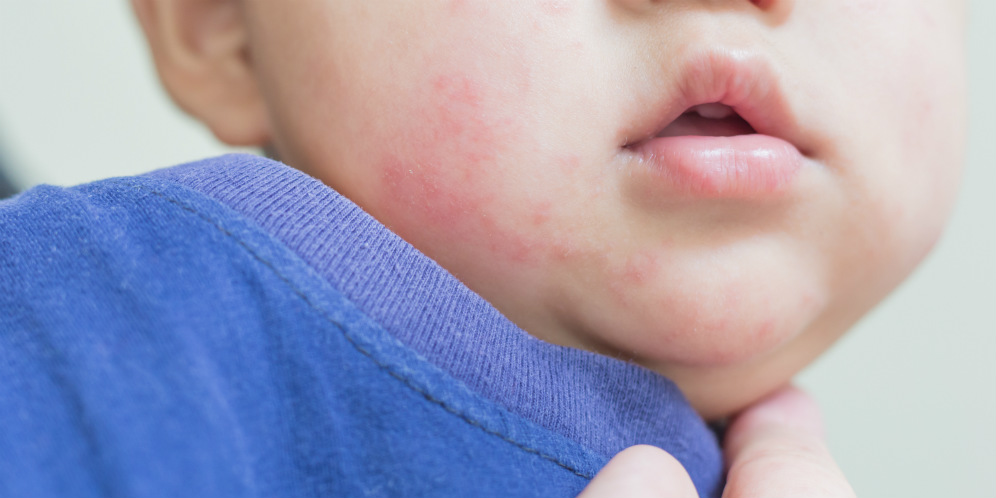 Alergi Bisa Hambat Tumbuh Kembang Anak, Segera Deteksi Dini