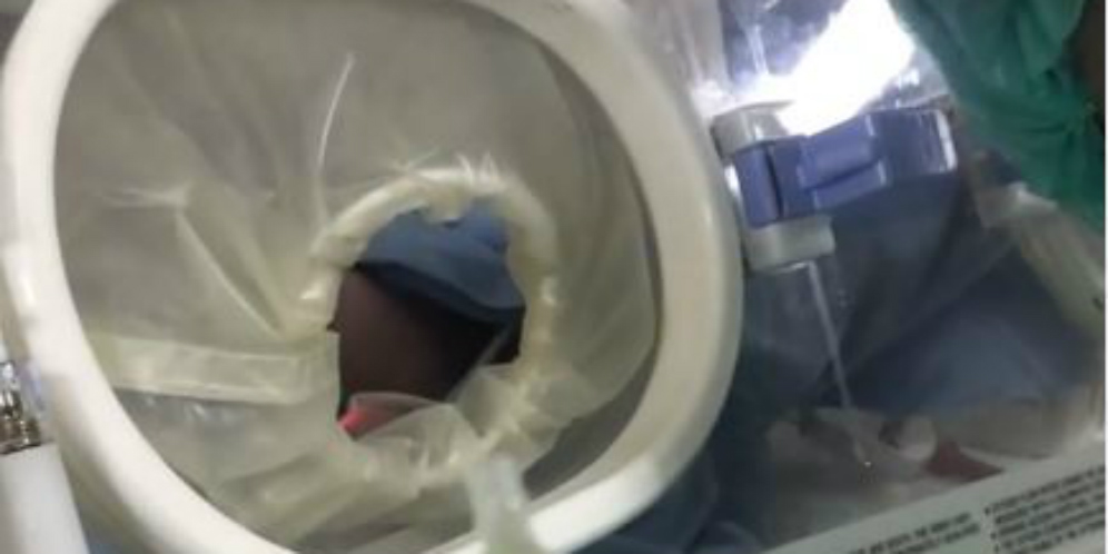 Dokter Anak Bagikan Video Pemberian Kolostrum Pada Bayi yang Lahir Caesar