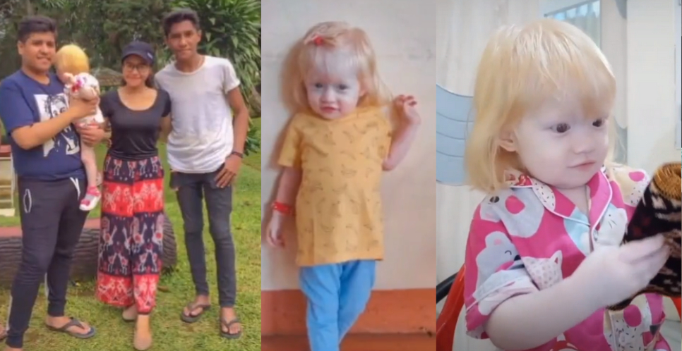 Claudia, Anak NTT yang Viral karena Beda dari Kakak, Bukan Albino