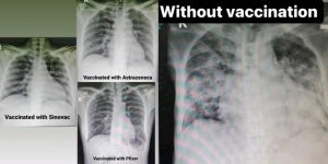 Ternyata Begini Perbedaan Paru-paru Pasien Covid yang Sudah dan Belum Vaksin