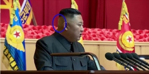 Plester Misterius di Kepala Kim Jong Un Picu Spekulasi