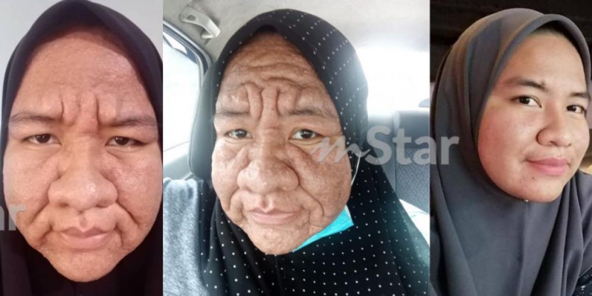 Wanita Hamil Alami Kondisi Aneh Wajah Bengkak Dan Keriput Mirip Nenek