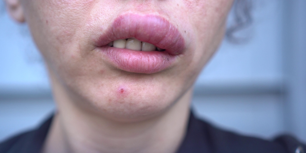 Bibir Bengkak Dikira Bisul, Saat Ditekan Dokter Keluar Larva Lalat Botfly