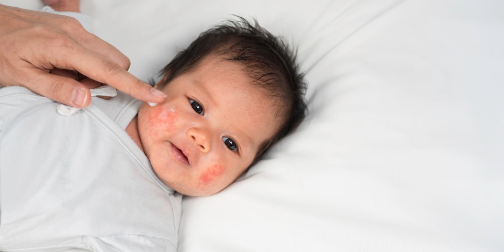 Kulit Bayi Lebih Tipis, Dokter Ingatkan Cara Merawatnya