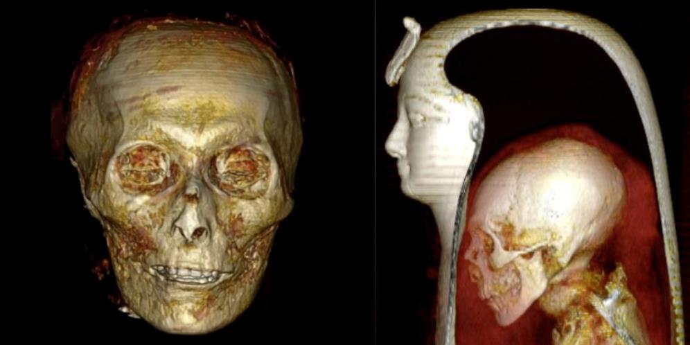 Mumi Firaun Berusia 3.500 Tahun Dibuka Perbannya untuk Pertama Kali, Ternyata Begini Penampakannya