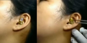 Video Mengerikan Telinga Wanita Kemasukan Ular dan Sulit Ditarik Keluar, Salah Masuk Lubang?