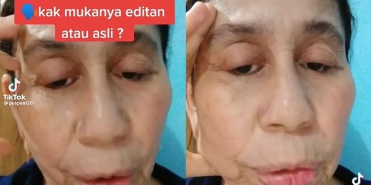 Idap Penyakit Langka Wajah Wanita 28 Tahun Ini Berubah Seperti Wanita