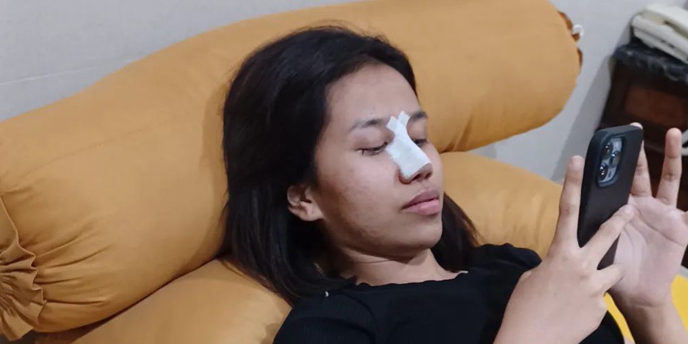 Potret Mayang Putri Doddy Sudrajat Oplas Hidung, Sempat Tidak Boleh Berbicara