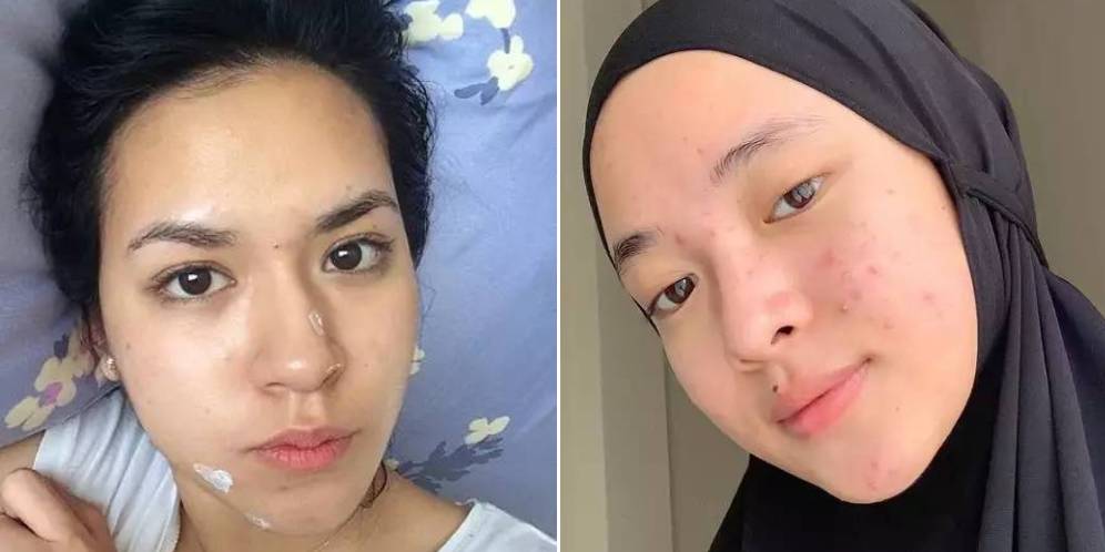 Potret Seleb Pamer Foto Selfie Wajah Penuh Jerawat