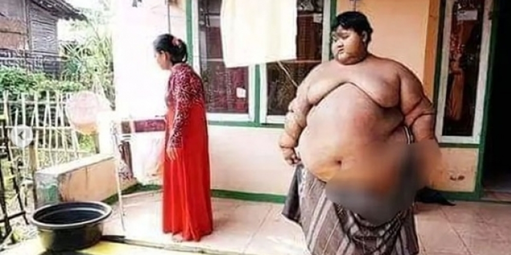 Masih Ingat Arya Permana Bocah Viral Berbobot 190 Kg? Penampilannya Berubah Drastis Usai Operasi & Diet, Bikin Pangling!