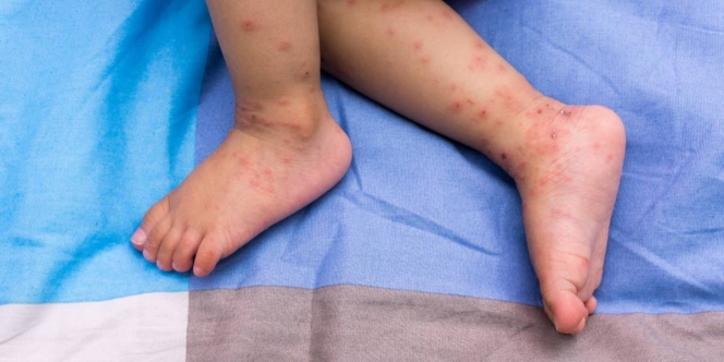 Kemenkes Tetapkan KLB Campak di 31 Provinsi, Jangan Tunda Vaksinasi 