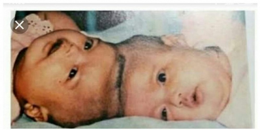 Ingat Bayi Kembar Siam Yuliana-Yuliani? Dulu Kelahirannya Viral Hingga Jadi Sejarah Bidang Kedokteran, Kini Kabar Terbarunya Mengejutkan!
