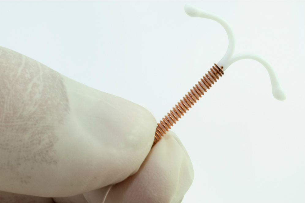 Pakai Kontrasepsi IUD Tetap Bisa 'Bobol', Lihat Buktinya