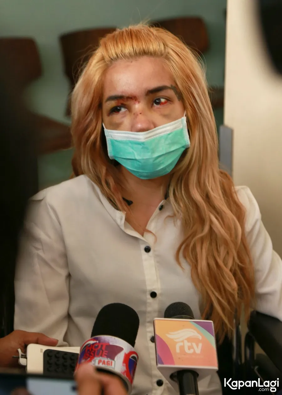 Sheila Marcia tak begitu ingat dengan kejadian pasca kecelekaan yang menimpa dirinya dan Vanessa © KapanLagi.com/Agus Apriyanto